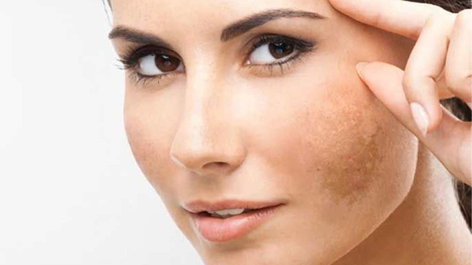آشنایی با انواع لک صورت و روشهای مؤثر درمان آن